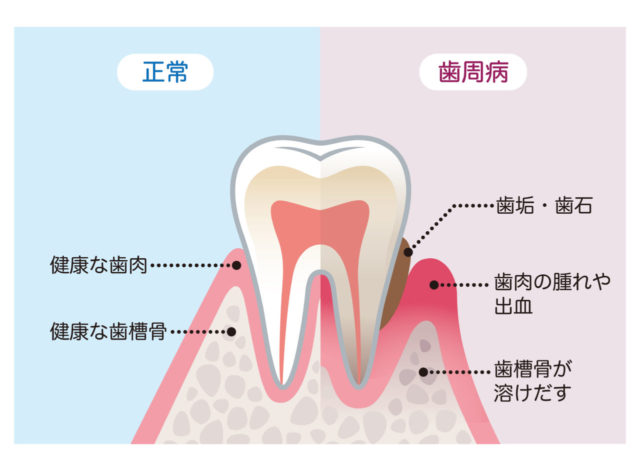 歯周病はオーラル・フレイルを引き起こす原因の一つ