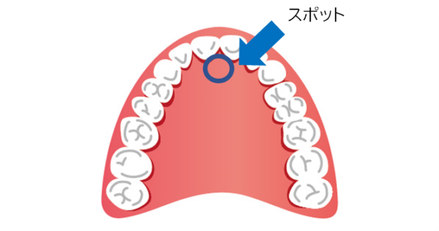 スポットに舌を置く癖は歯並びの乱れを防止・唾液の蒸発防止になる