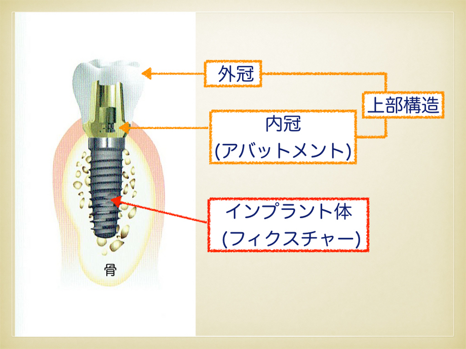 implant-001